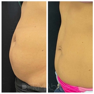 CoolSculpting - 2 treatments-before
