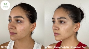 B&A 1 HydraFacial & 1 Chemical Peel-before