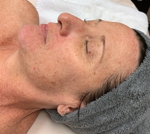 IPL photo facial-before