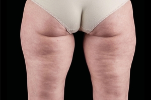 4 Treatments-before