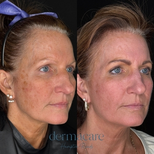 Halo - Carrie Labert PA-C-before