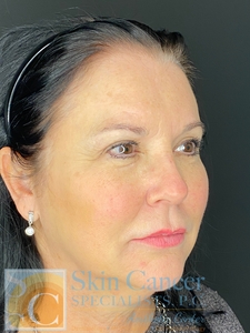 Nova Threads and Voluma Filler-before