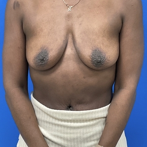 Breast Augmentation #6 350 cc-before