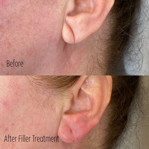 Filler B/A SBA 17-before