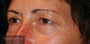 Upper & Lower plus Fat Graft-before