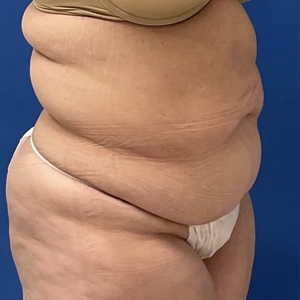 Mommy Makeover #2-before