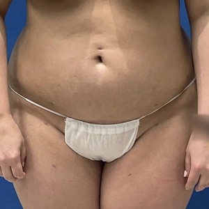 Lipo w Renuvion #2-after