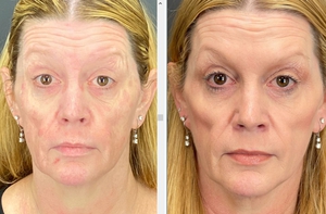 Botox - 20 u forehead, 24 u cf-before