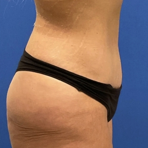 Tummy Tuck #34 (right)-after