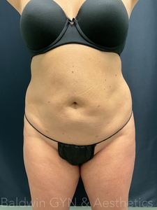 LIPO 2.0-after