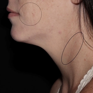 Lipo w Skin Tightening Face #4-before