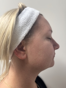 Before and After Side Profile Fire and Ice Facial-before