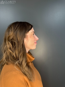 crow's feet (right)-before