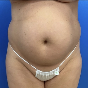 Lipo w Renuvion #3-before