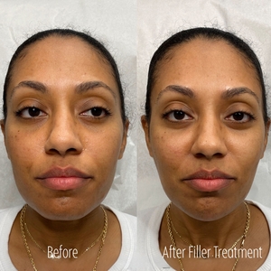 Filler B/A SBA 8-before