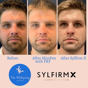 Goals were to tighten & lift while destroying fat under the chin-before