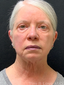 MyEllevate with Upper Bleph-after