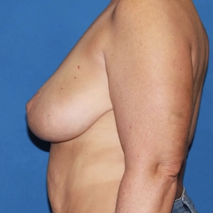 Breast Lift #3-after