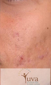 6 TX microneddling at Yuva-after