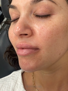 Whitney Devall RN.-before