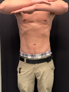 Male-LAL lower abdomen + waist-before