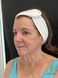 One XERF treatment-before