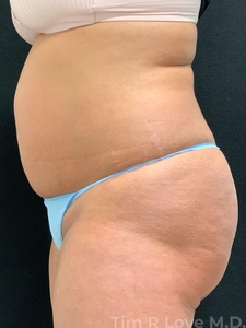 52 year old, 5'2 150lbs, 1 mo post op-before