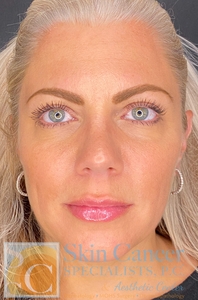 Lip Filler and Dysport-after