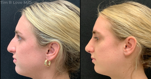 22 years old, This patient is 2 weeks post-op.-before