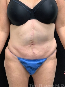 Abdominoplasty - Traditional-before