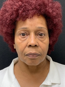 68 years old, orbital fat grafting-before