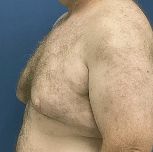 Male Breast Reduction #3 (left)-before