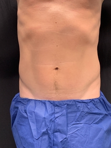 Male-LAL lower abdomen + waist-after