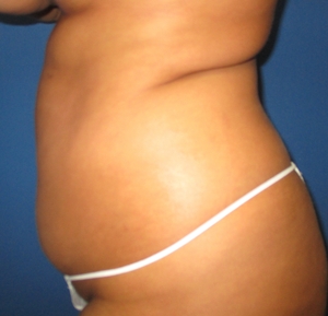 Liposuction #1-before
