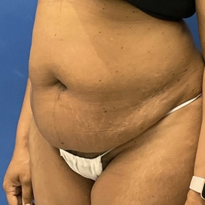 Lipo w Renuvion #6-before