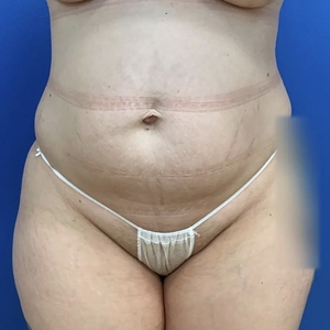 Lipo w Renuvion #8-before