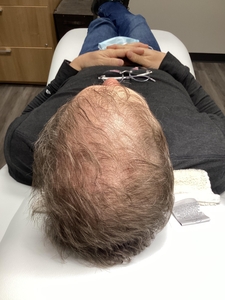 First Round of PRP for Plaque Psoriasis and thinning hair-before