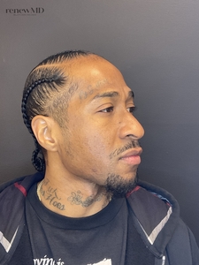 MIRCONEEDLING PRP-after