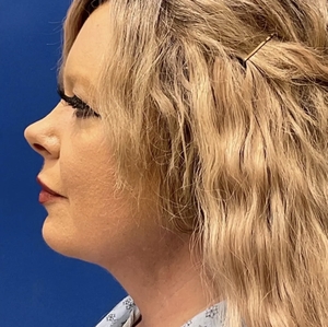 Lipo w Skin Tightening Face #2-after