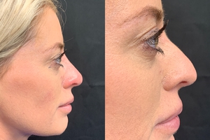 Liquid Rhinoplasty-before