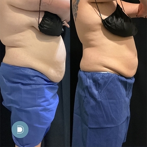 Coolsculpting-before