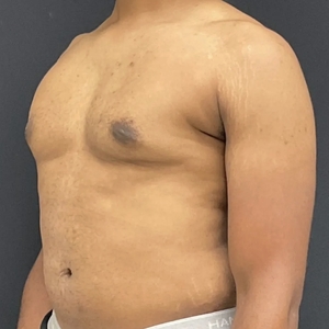 Lipo w BodyTite #9-after