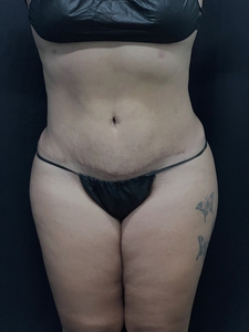 LAL-upper + lower abdomen-before