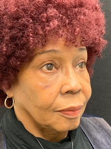 7 months post op-after