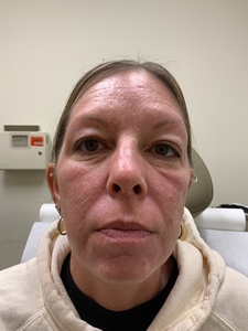 Treatment for acne scarring-before