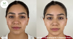 B&A 1 HydraFacial & 1 Chemical Peel-before
