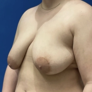 Breast Lift #5-before