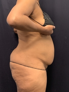 Lipo 360 + mini tummy tuck-before