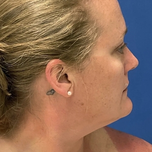 Lipo w Skin Tightening Face #7-before