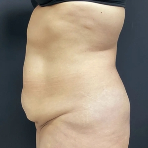 Tummy Tuck #13-before